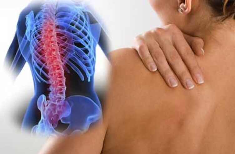Durante la exacerbación de la osteocondrosis de la columna torácica, se produce dolor en el dorsago. 