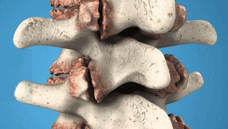 Osteófitos espinales como causa de dolor lumbar