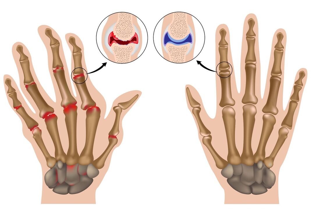 Articulaciones de manos sanas y poliartritis afectada