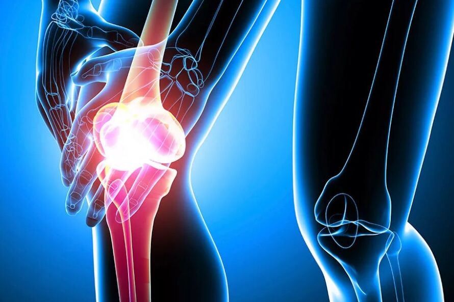 Artrosis de rodilla