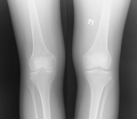 Radiografía de la articulación de la rodilla