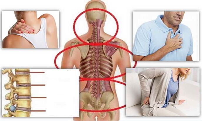 Un lugar de enfermedad para la osteocondrosis