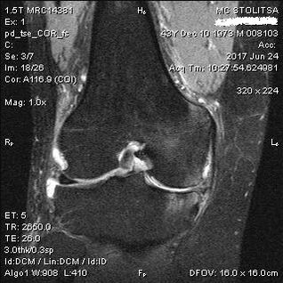 Osteoartritis de la articulación de la rodilla en resonancia magnética