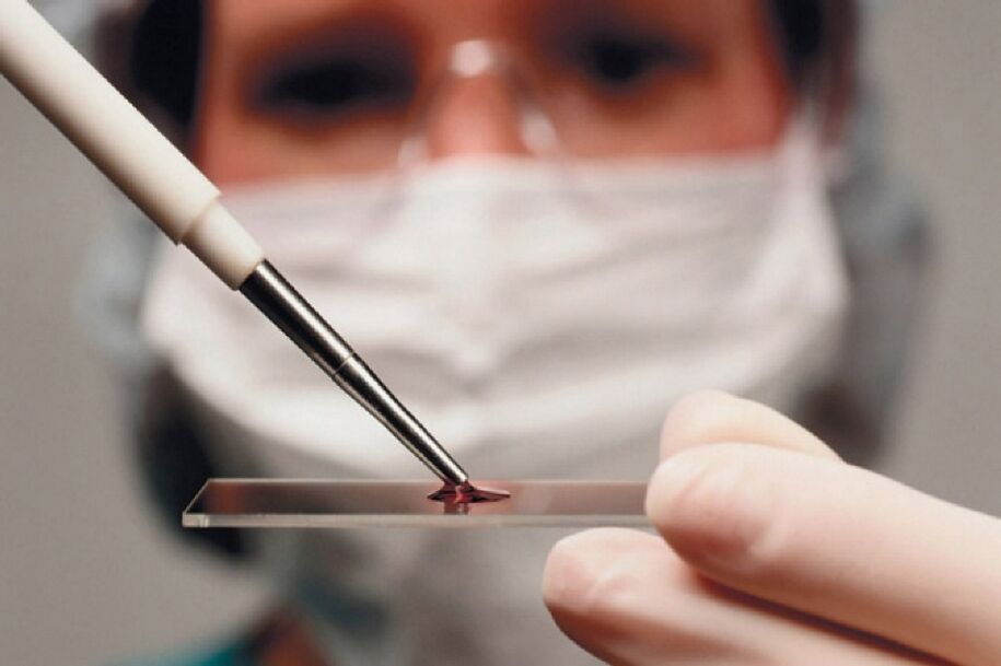 La artritis es una enfermedad inflamatoria y su presencia se revela mediante un análisis de sangre.