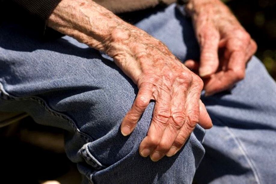 La artritis es una enfermedad relacionada con la edad que se presenta en personas mayores.