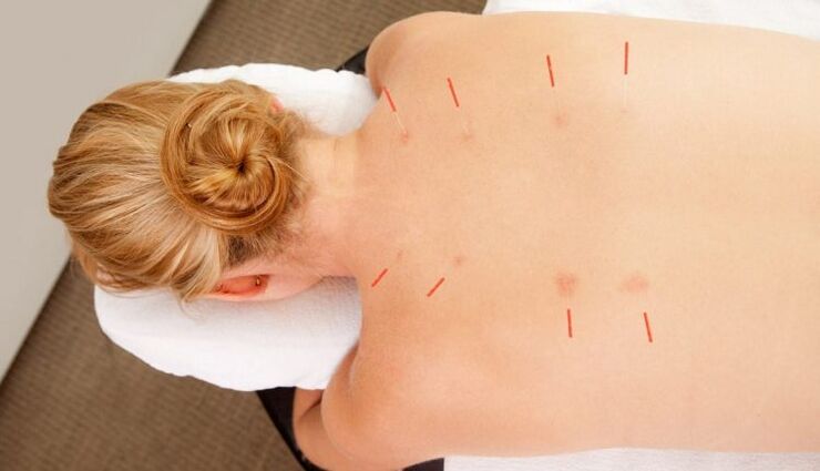 Acupuntura para la osteocondrosis torácica, que tiene muchas ventajas.