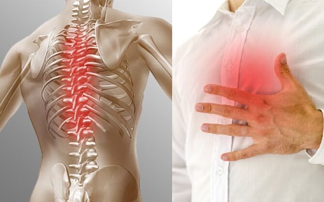 La osteocondrosis torácica está indicada por dolor y opresión en el pecho.